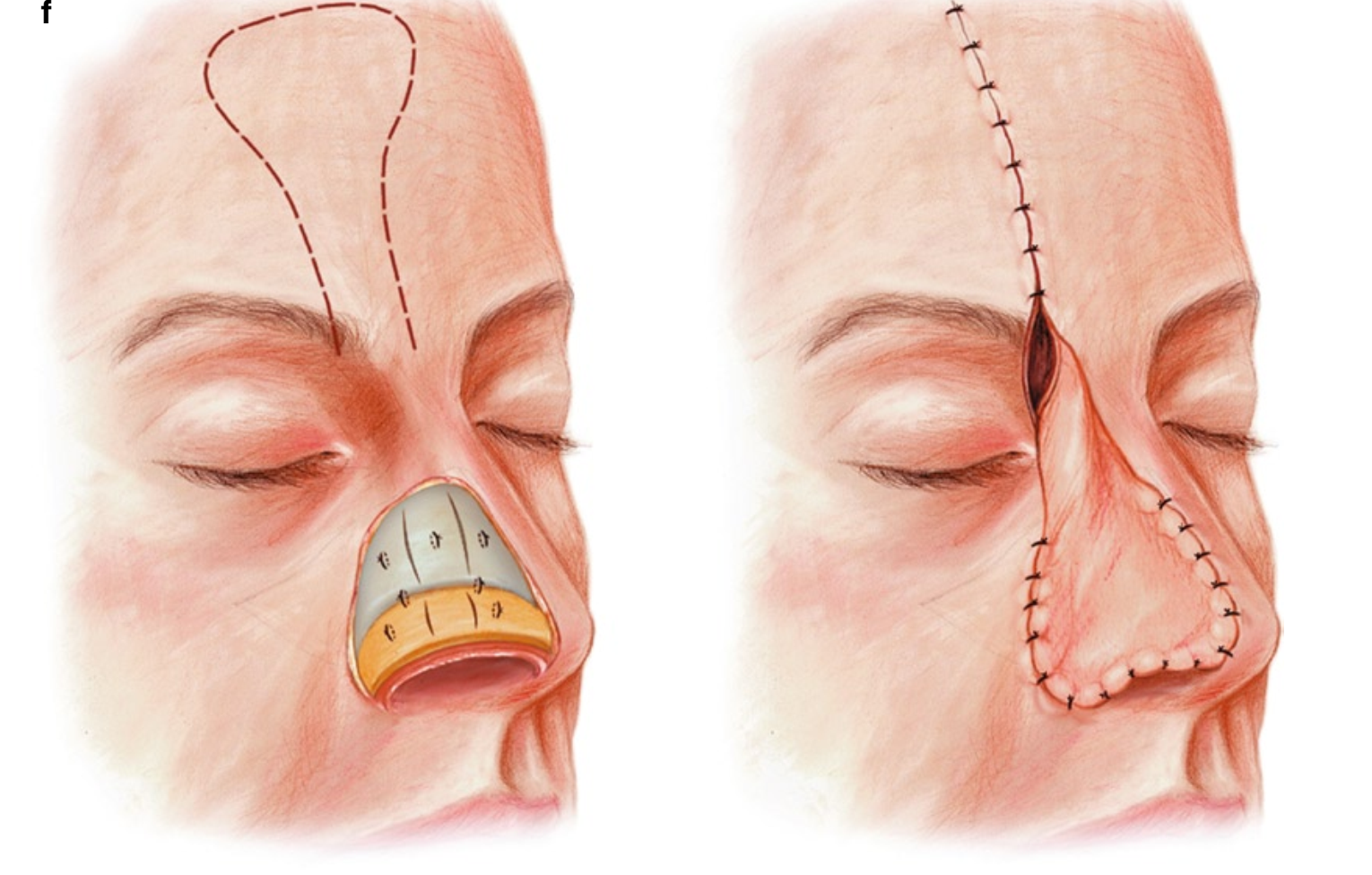 PT tạo hình mũi: che phủ mất da mũi bằng vạt trán